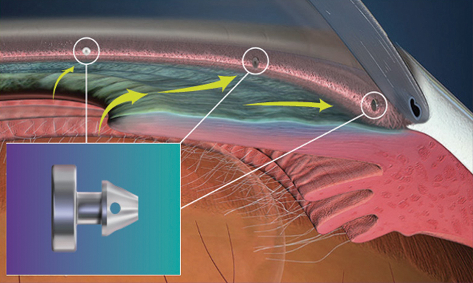 愛視坦iStent小樑微導流支架與眼內置放位置示意圖